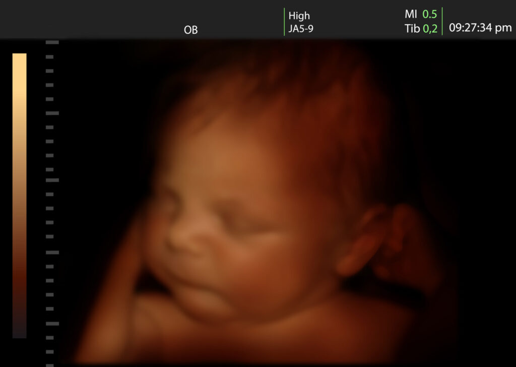 La Cour suprême des États-Unis renverse l’arrêt Roe v. Wade : les États sont libres de déterminer eux-mêmes leur législation relative à l’avortement